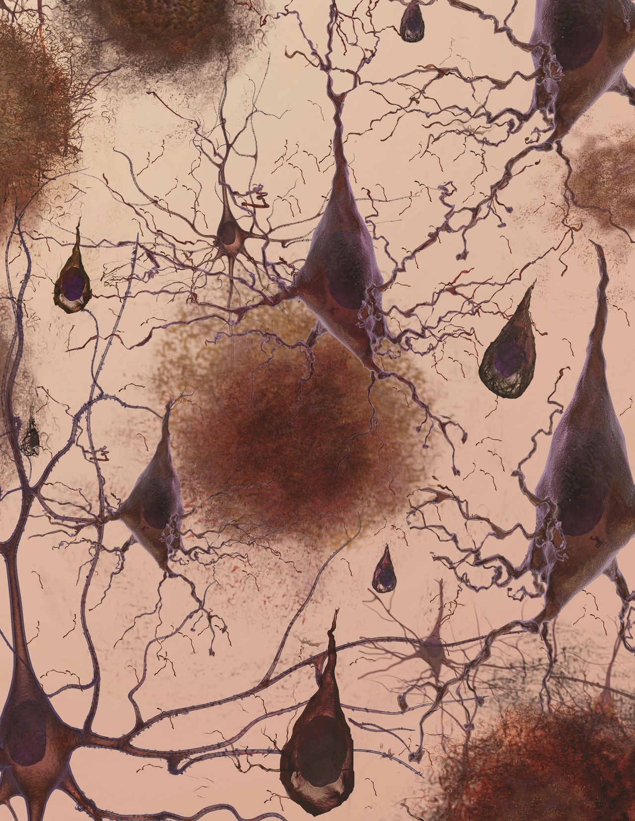 Loss of connection between brain cells. Image Credit: National Institute on Aging/National Institutes of Health