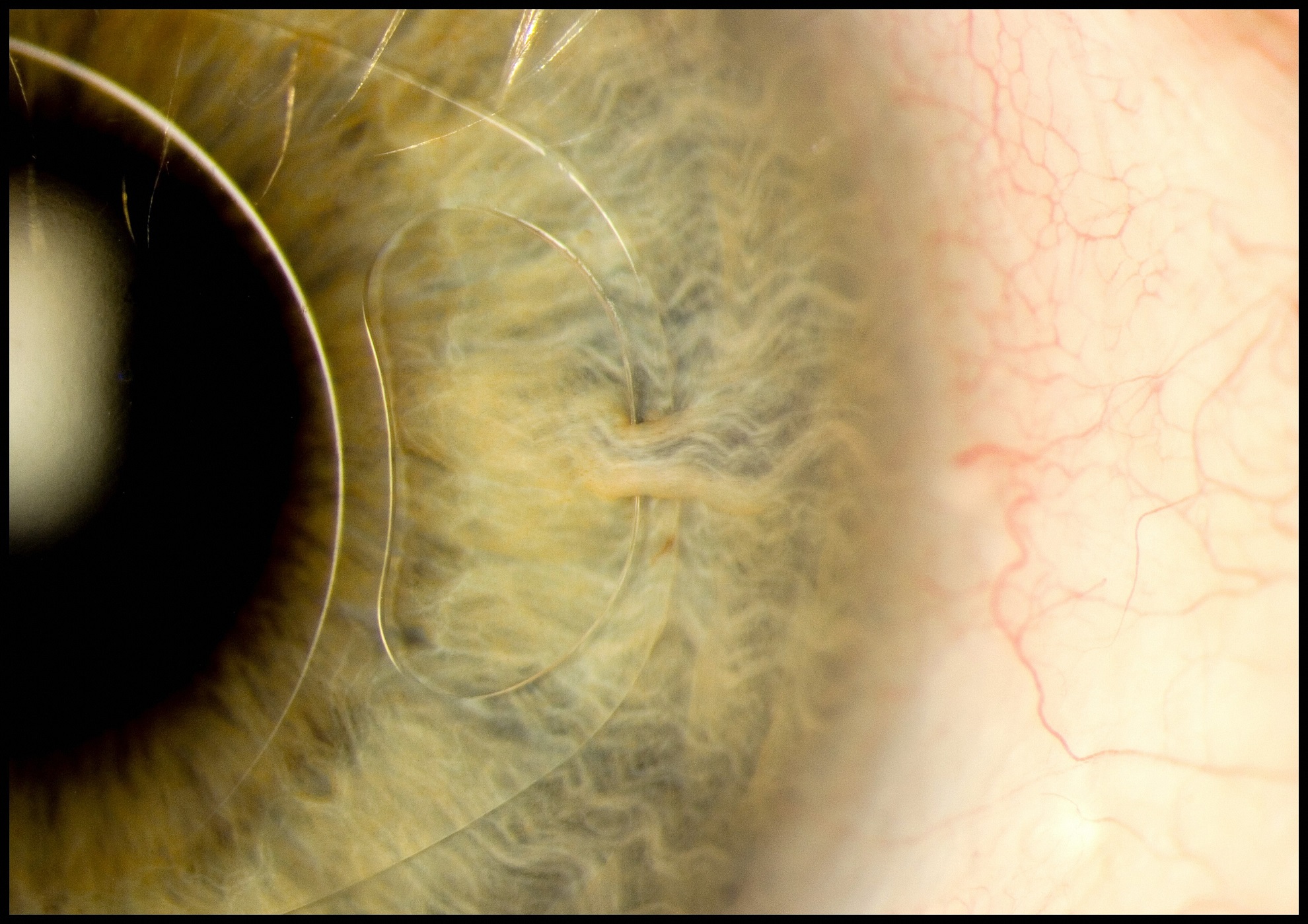 This image shows how an ‘iris clip’, also known as an artificial intraocular lens (IOL), is fitted onto the eye. An iris clip is a small, thin lens made from silicone or acrylic material, and has plastic side supports, called haptics, to hold it in place. An iris clip is fixed to the iris through a 3 mm surgical incision, and is used to treat conditions such as myopia (nearsightedness) and cataracts (cloudiness of the lens). This particular patient, a 70-year-old man, regained almost full vision following his surgery.